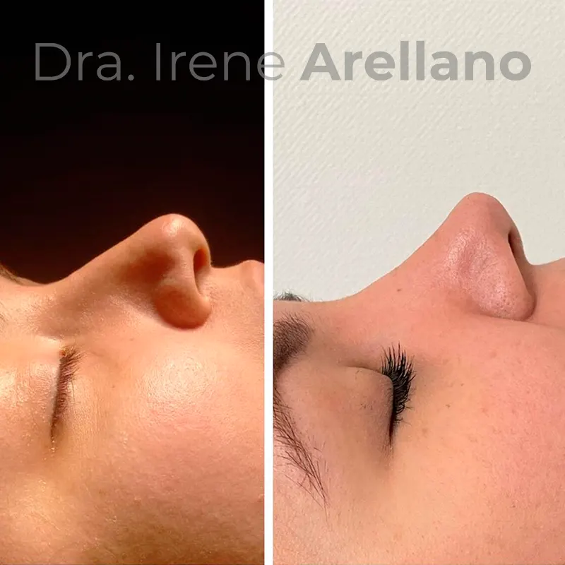 Dra. Irene Arellano - Rinoplastía